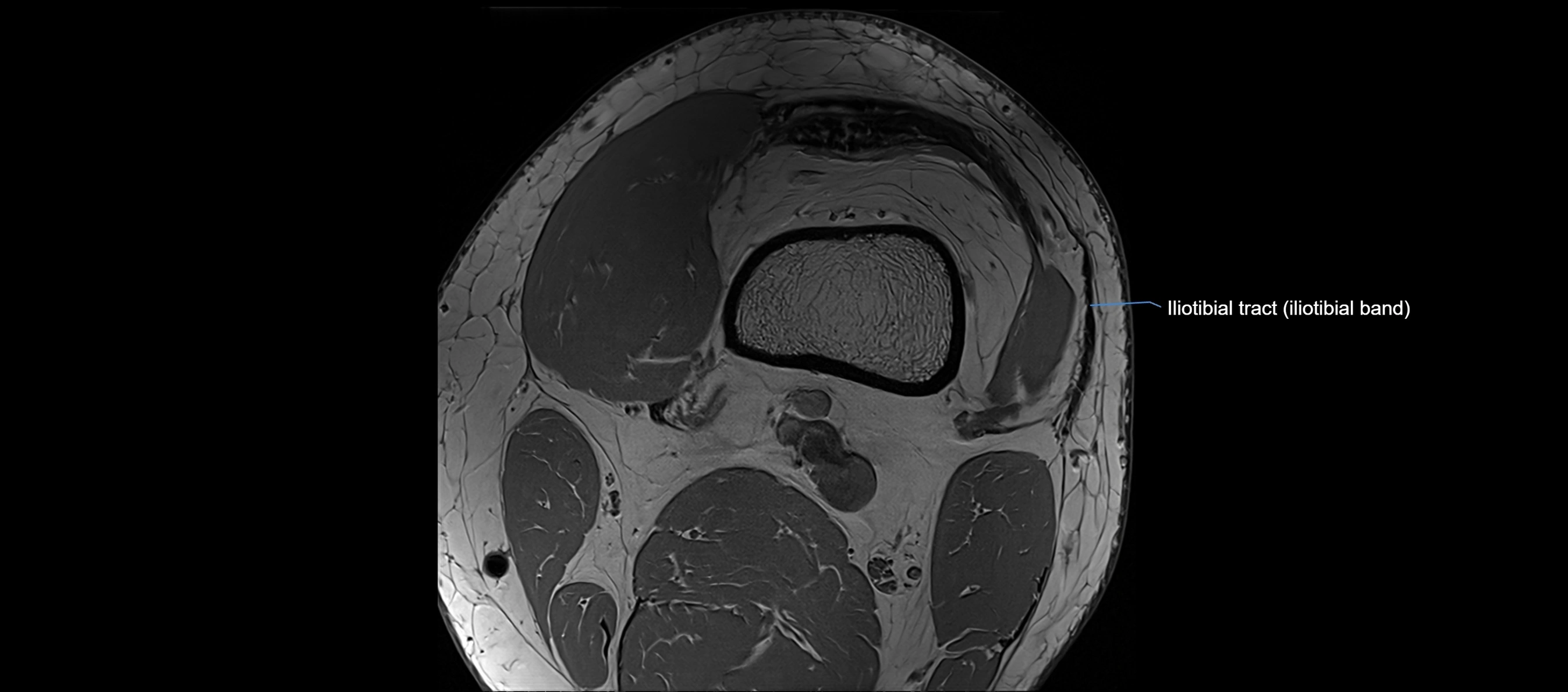 MRI Knee axial  ligaments cross sectional anatomy 3T  radiology  image-img-03001-00002.webp
